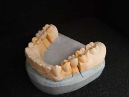 Elemente protetice metalice